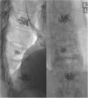 Outcomes of percutaneous vertebroplasty in multiple myeloma: a tertiary neurosciences experience with long-term follow-up